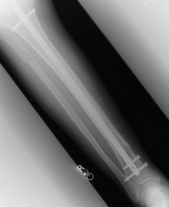 broken leg with pins